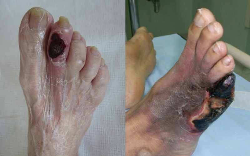 diabetes-foot-wounds-ulcers