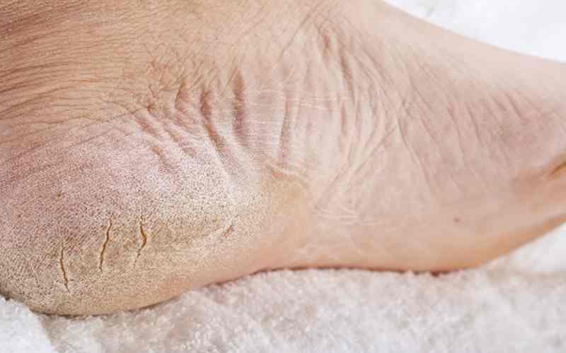 diabetes-foot-skin-cracks 