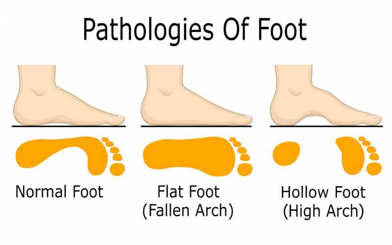 diabetes-pathologies-foot