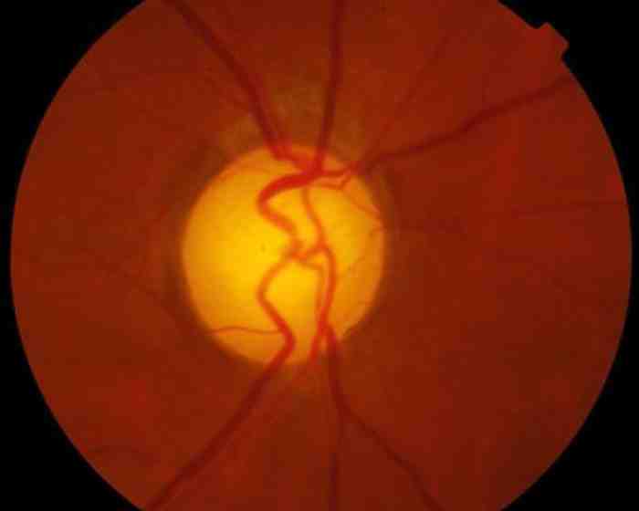 glaucomatous-optic-disc